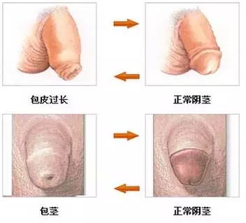 金华男科医院包皮手术费用统计